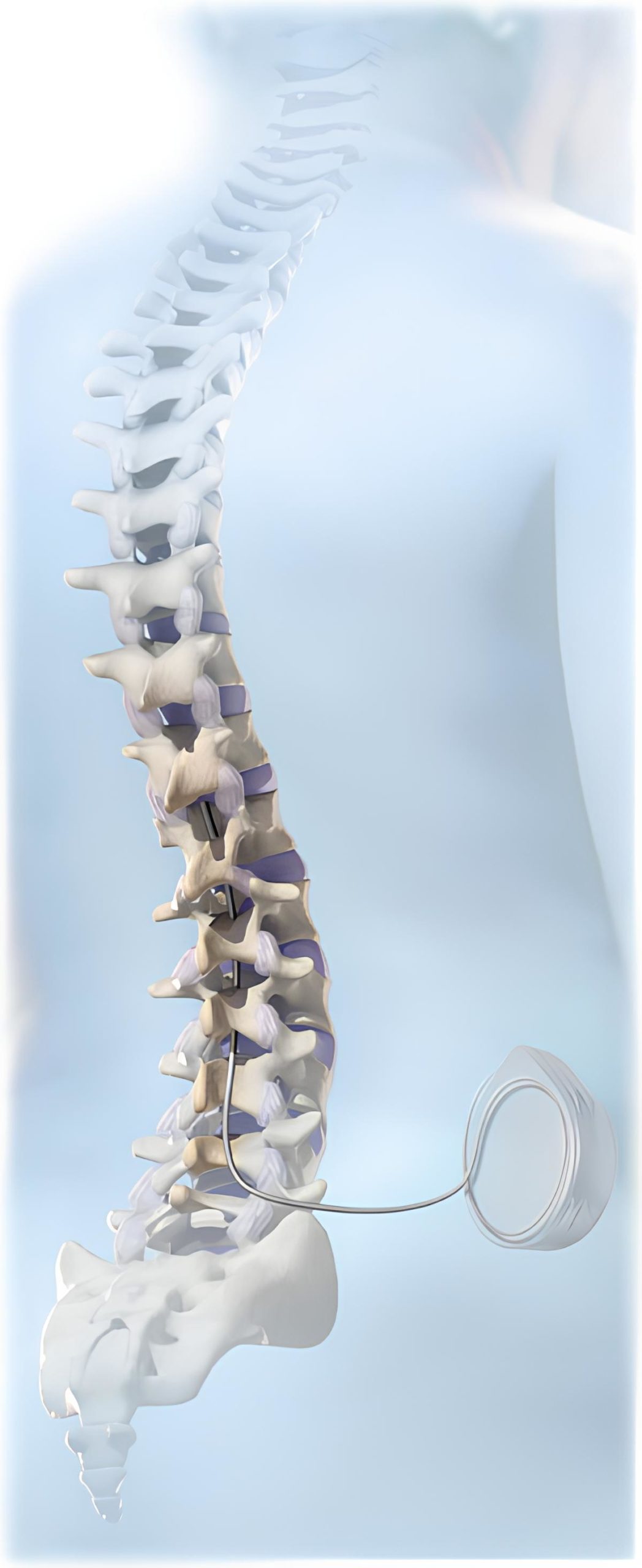 Benefits of Baclofen Pump Therapy for Dystonia and Spasticity