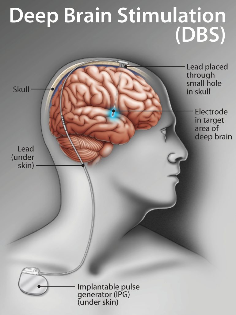 DBS Surgery - What to expect